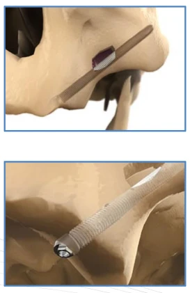 Zigomatic External Hex