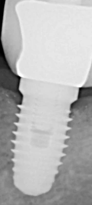 Nobel Replace External Hex (3.5) (Steri-Oss)