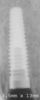 Nobel Replace -Taper NP (3.5)