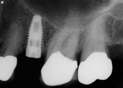 Nobel Replace -Taper RP (4.3)