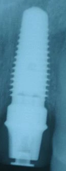 Nobel Replace -Taper 6.0 (6.0)