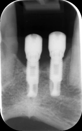 Branemark System MK II-RP (4.1)