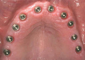 Branemark System MK III-Shorty-wide platform (5.1)