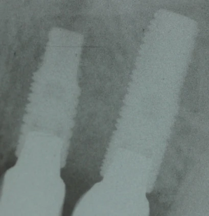 GS (HG) II Mini (3.5)