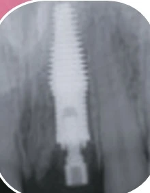 External Hex INVERTA Co-Axis 5.2mm-6.0mm