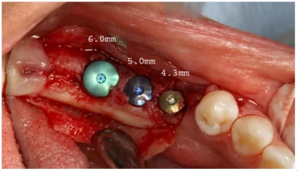 Tri-Nex Co-Axis IA50-12d (4.3)