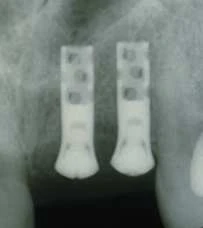 Hollow Cylinder Esthetic Plus 3.5 (4.8)