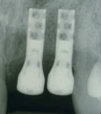 Hollow Cylinder Esthetic Plus 3.5 (4.8)