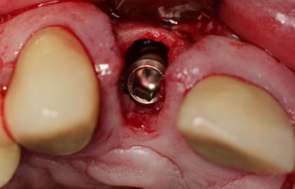 SybronPro XRT HEX (4.1)