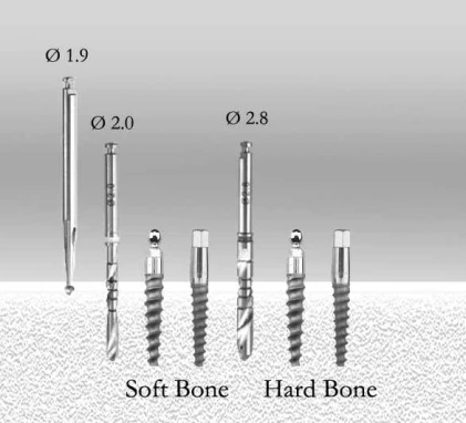 Tidal Monoblock Implant (TSM)