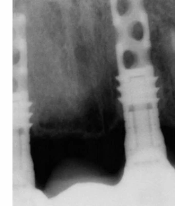 Core-Vent SD (3.5) (Paragon)