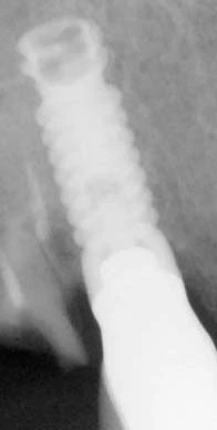 Micro-Vent MD (4.25,4.7) (Paragon)