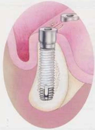 Taper-Lock Screw (4.1) (Paragon)