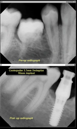 SwissPlus Tapered (4.8)