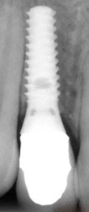 SwissPlus Tapered (4.8)