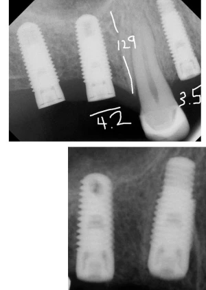 Tapered Screw Vent (3.5)