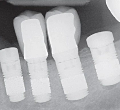 Trabecular Metal (3.5)