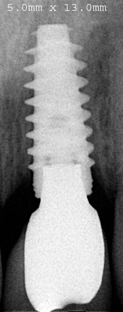 Dental Healing Abutment Caps For Nobel Active Implants - RP & NP, Multiple Diameters & Heights (3.6/5.0/6.0mm, H3/5/7mm)